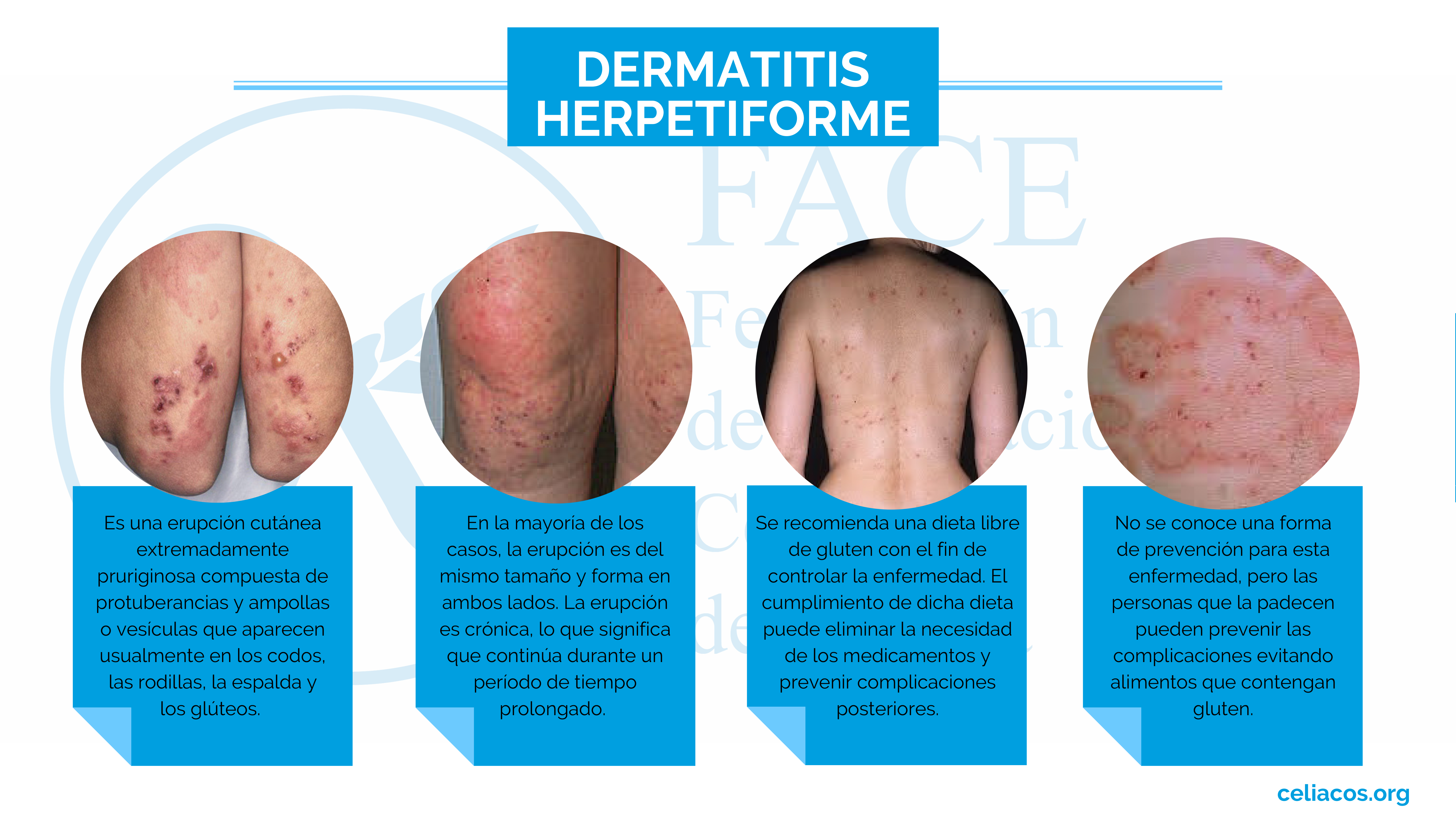 Dermatitis Herpetiforme